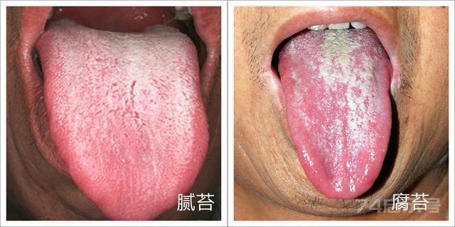 舌诊中，舌苔怎么看？苔质代表什么？中医教你望舌，有对比更简单