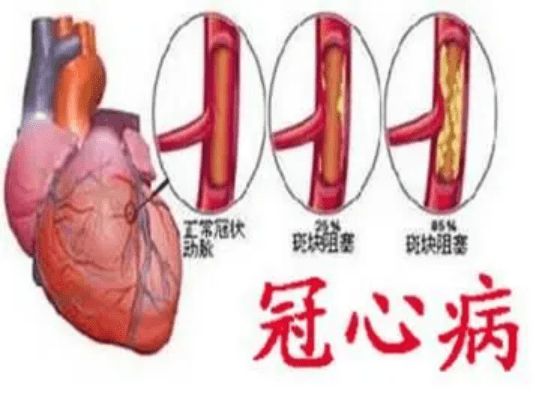 全球排名第一的死亡原因——缺血性心脏病