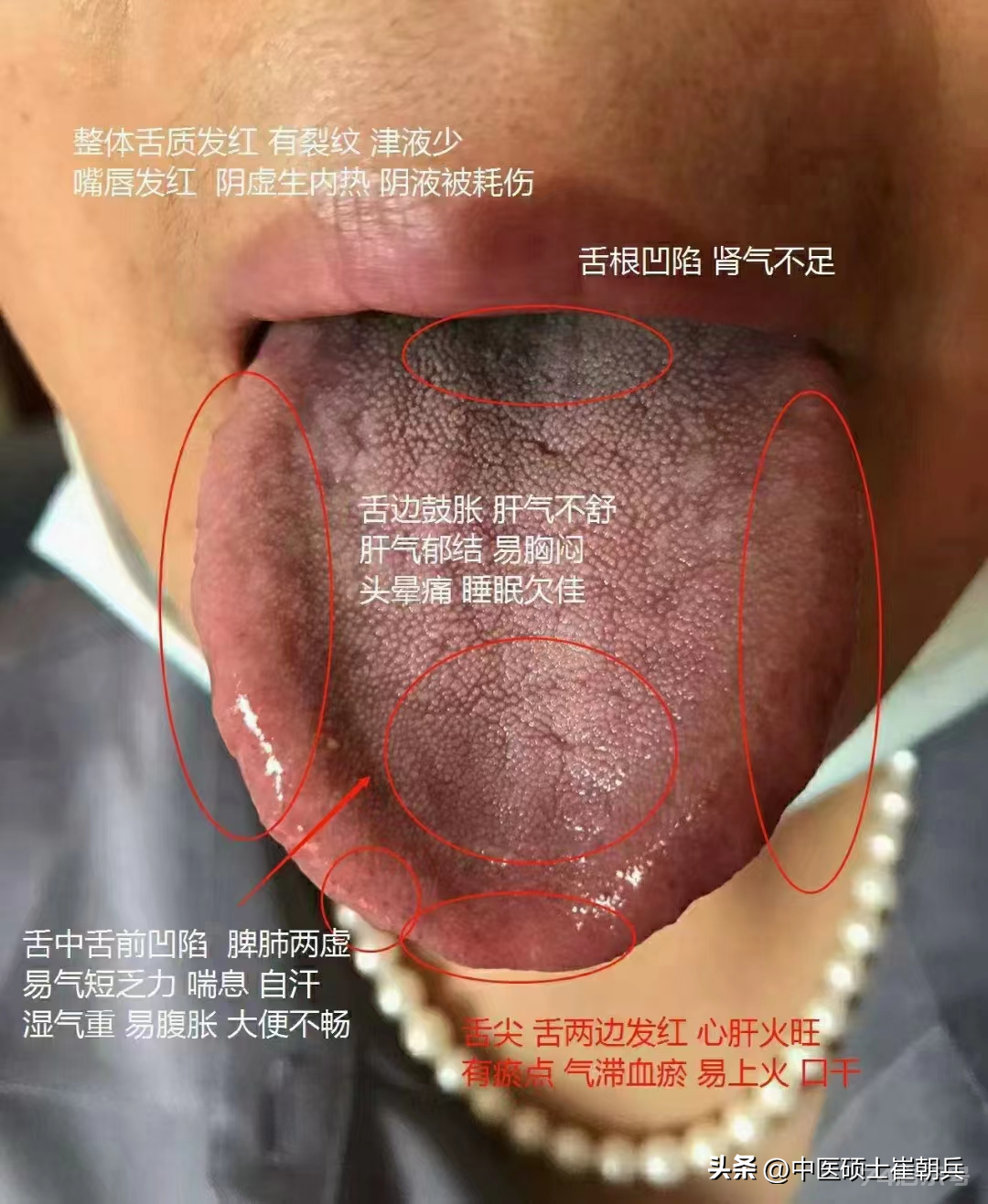 今日舌诊分享：脾肺两虚、阴虚舌像分享 中焦 这个舌头像一个勺子一