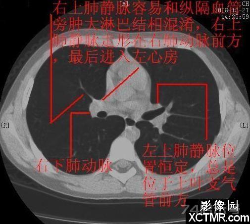 胸部CT断层解剖纵隔血管气管分支标注详解