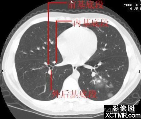 胸部CT断层解剖纵隔血管气管分支标注详解