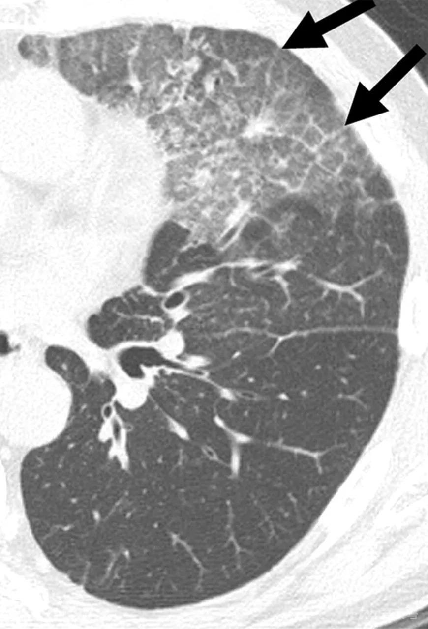 职业病--尘肺：影像和病理结果对比