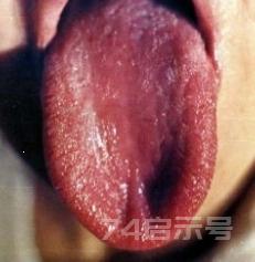 李芳祥讲中医诊断 舌诊内容（配图）