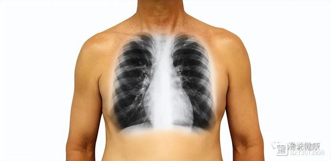 肺部检查有阴影是癌症吗？还可能是这2种因素