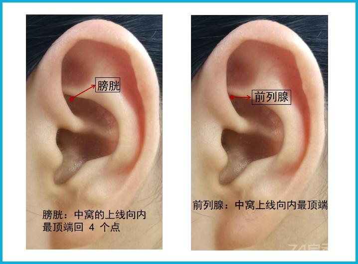 前列腺的耳穴疗法