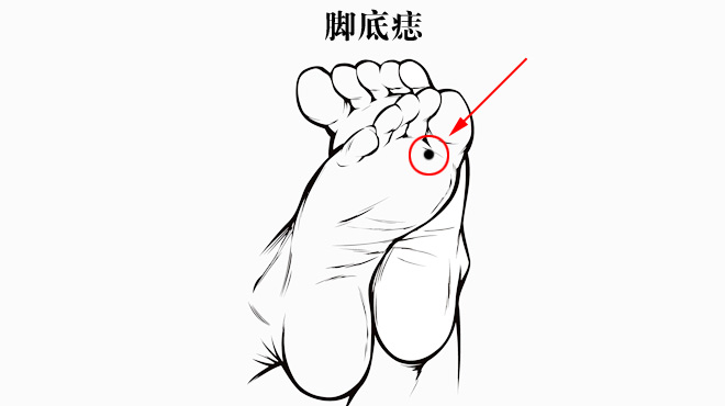 脚底长痣_脚底长小水泡很痒_脚底长小水泡