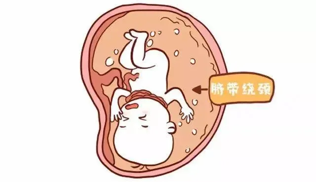 脐带绕颈宝宝_脐带绕颈部的胎儿_胎儿脐带绕颈