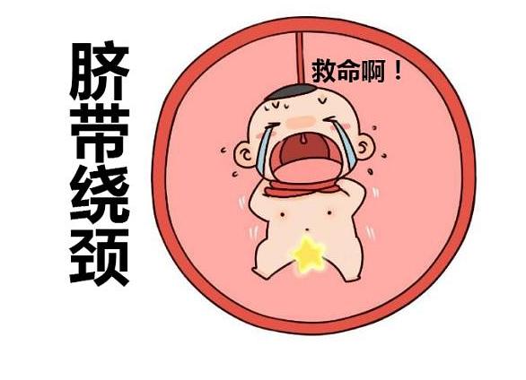 脐带绕颈部的胎儿_脐带绕颈宝宝_胎儿脐带绕颈
