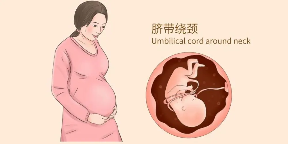 脐带绕颈部的胎儿_胎儿脐带绕颈_脐带绕颈宝宝
