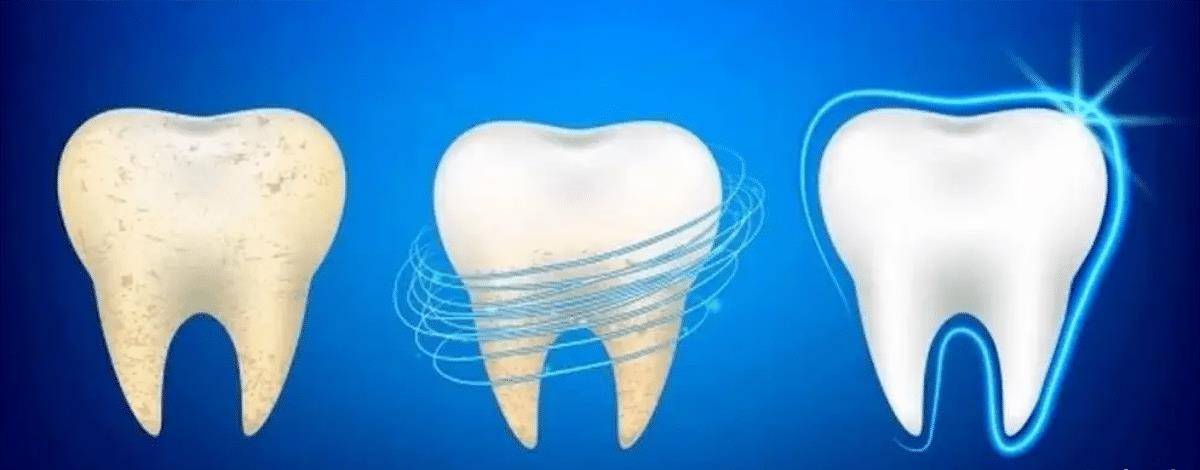 美白牙齿会有伤害吗？