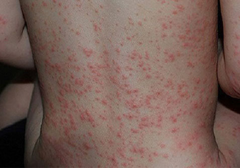 全身皮疹荨麻疹图片和症状