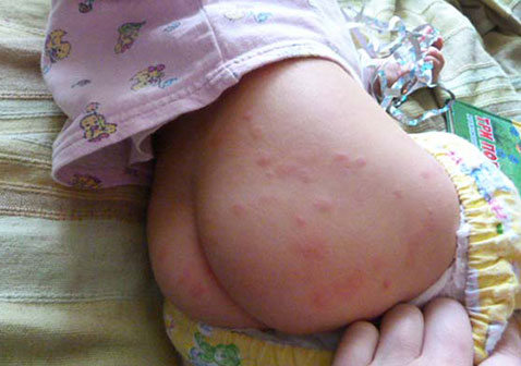 儿童屁股荨麻疹图片和症状