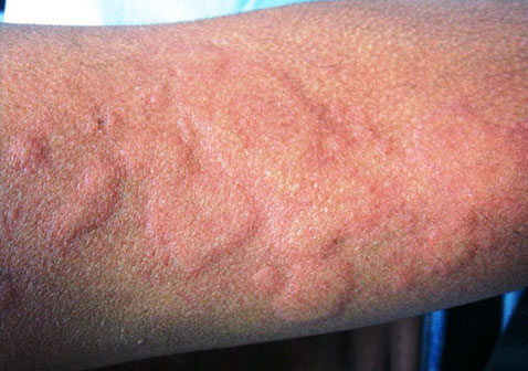 手臂上大片荨麻疹图片和症状样子