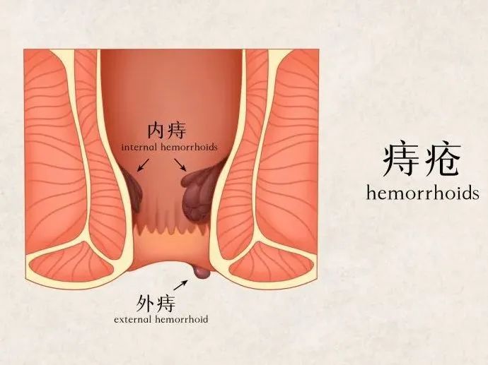 内痔手术_手术内痔脱落会流很多血吗_手术内痔疮多久恢复