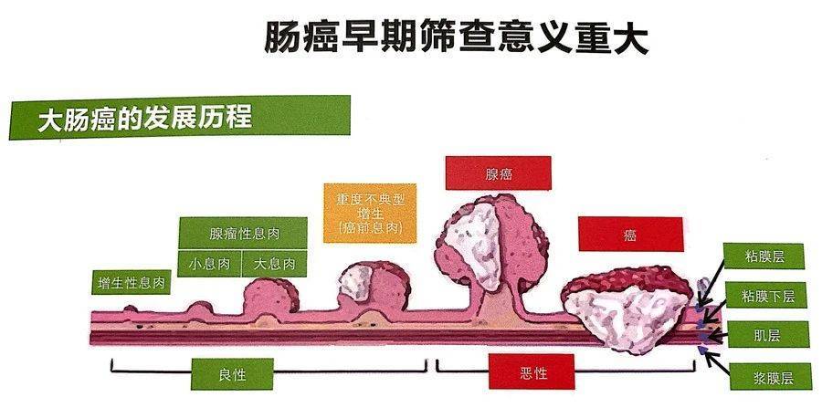 肠癌早期筛查方法有哪些?有几种方法?