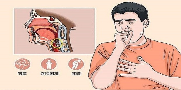 急性咽炎的治疗方法