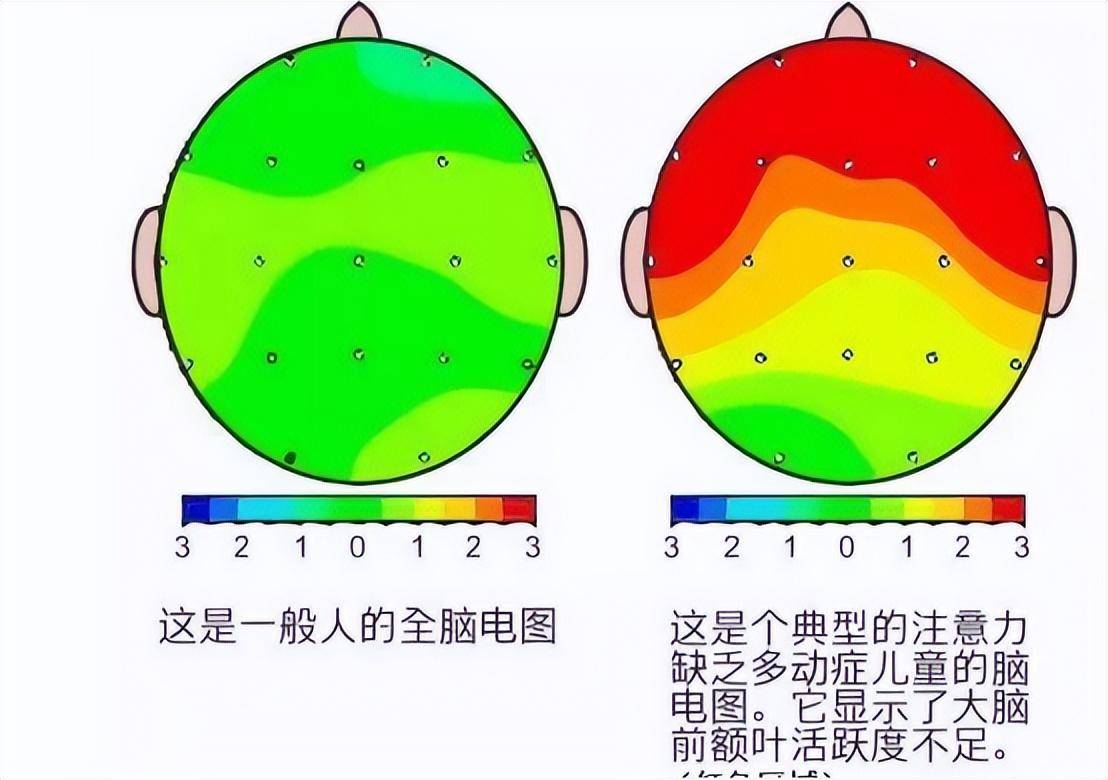 多动症的检查重点有哪些？干预方法有哪些？