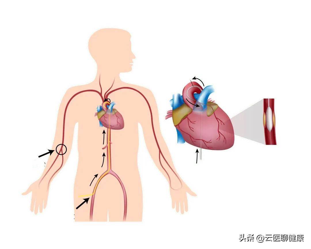 冠心病有哪些症状？治疗手段有哪些