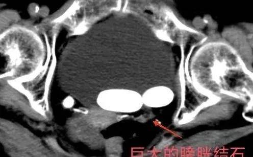 90岁老人家，依然可以行尿路结石的微创手术