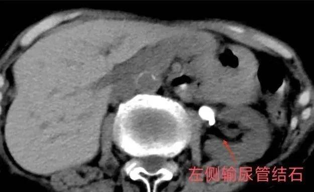 90岁老人家，依然可以行尿路结石的微创手术