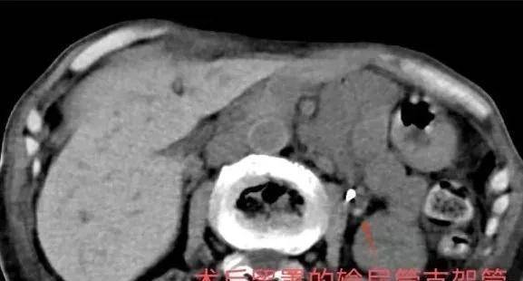 90岁老人家，依然可以行尿路结石的微创手术