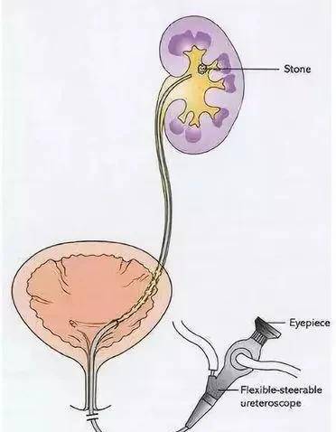 90岁老人家，依然可以行尿路结石的微创手术