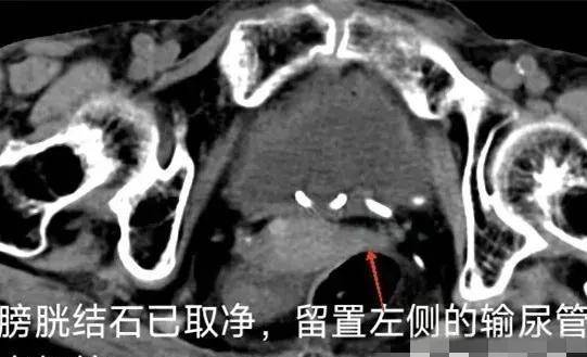 90岁老人家，依然可以行尿路结石的微创手术