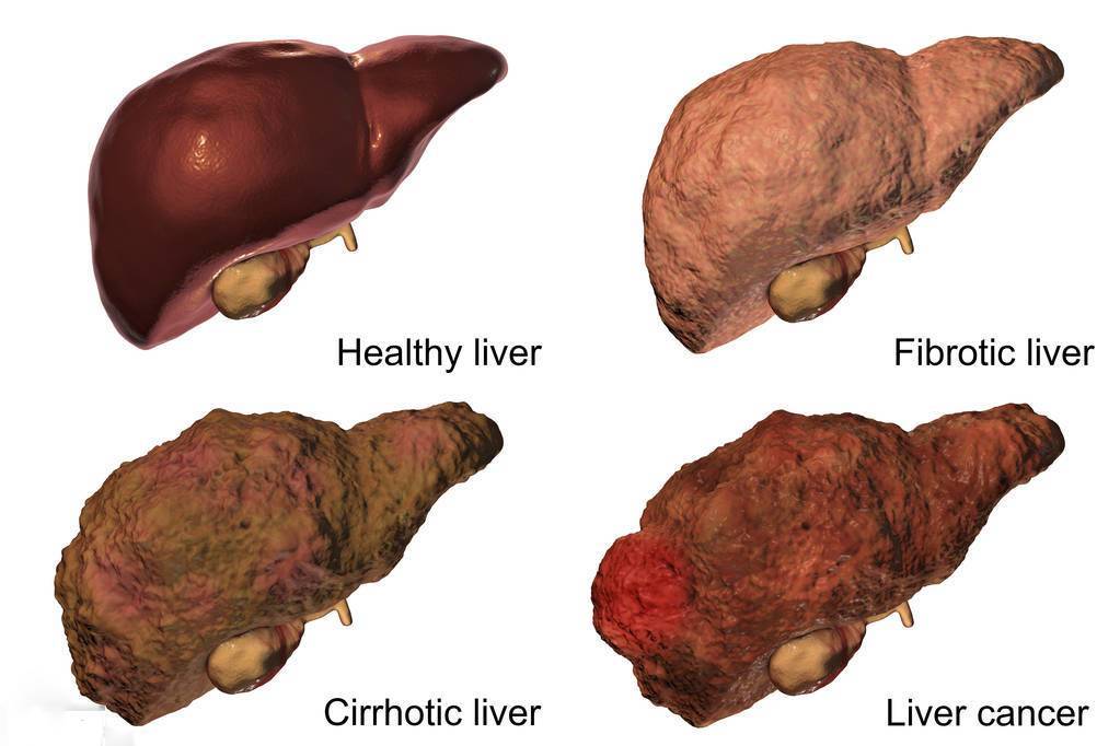 肝硬化最佳治疗方法_肺癌肝转移最佳治疗_保护肝脏的最佳方法