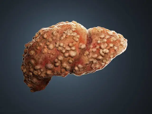 肝硬化最佳治疗方法_保护肝脏的最佳方法_肺癌肝转移最佳治疗
