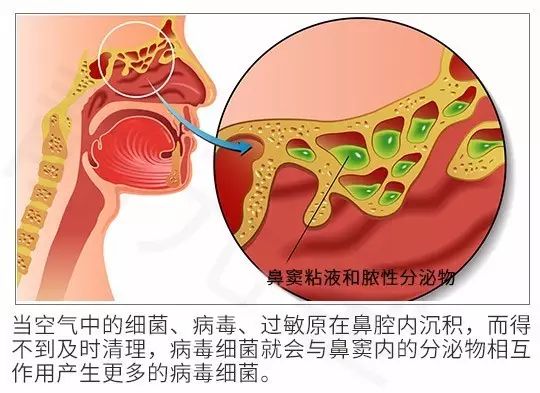 治疗鼻炎_沈阳鼻炎治疗_上海鼻炎治疗医院
