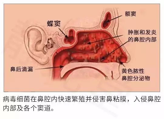 沈阳鼻炎治疗_治疗鼻炎_上海鼻炎治疗医院