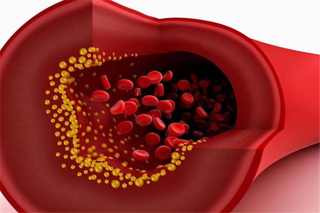 低密度脂蛋白超出3.94，或该注意，当心身体出现2个“隐患”