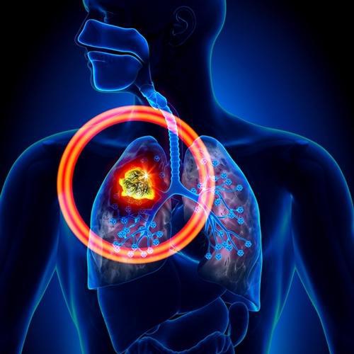 肺腺癌和肺鳞癌，哪个更严重？