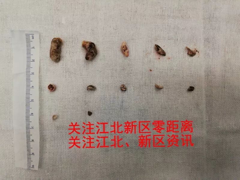 南京一女子胰管内惊现10多粒黑色小石块，丈夫欲带回家收藏