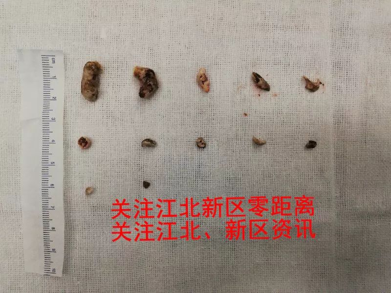 胰管_管胰腺炎的药_管胰腺的药