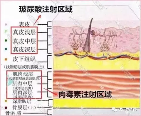 玻尿酸除皱可以维持多长时间_玻尿酸除皱针对身体有害吗_玻尿酸除皱