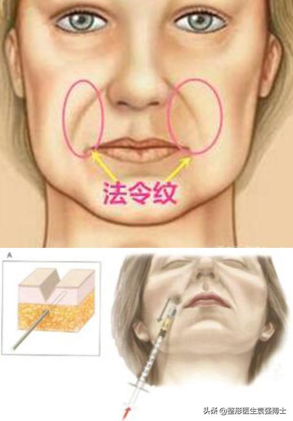 整形医生说：面部除皱这3种方法还不错