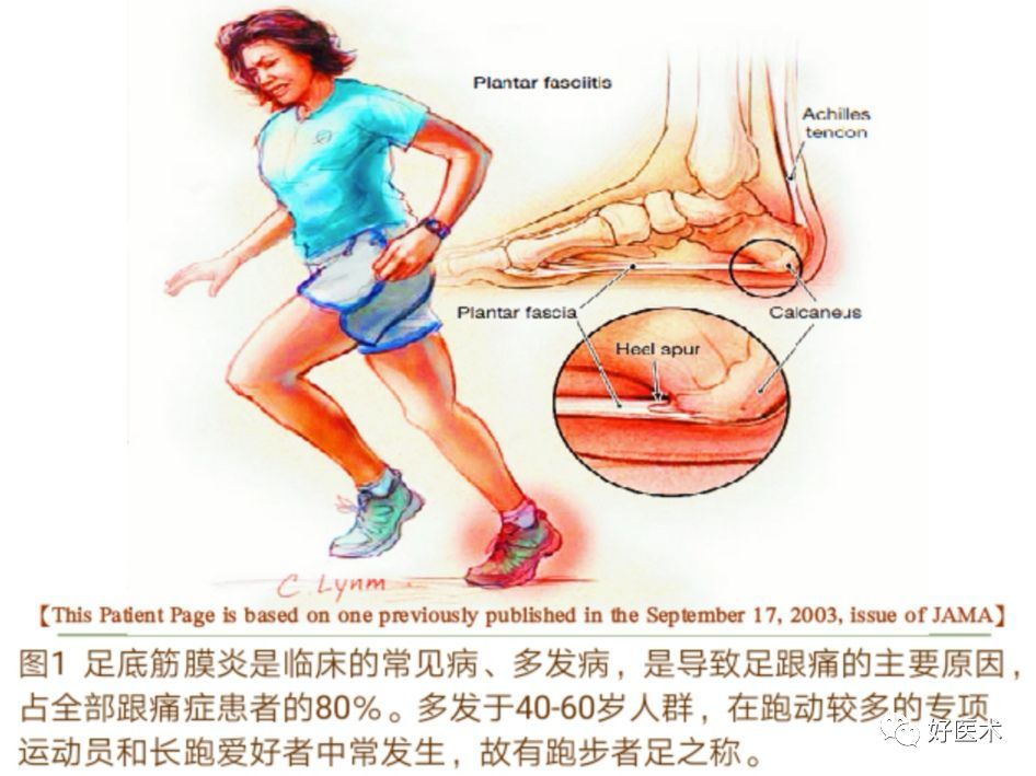 右脚底疼是怎么回事_脚底肾反射区疼_脚底板筋疼