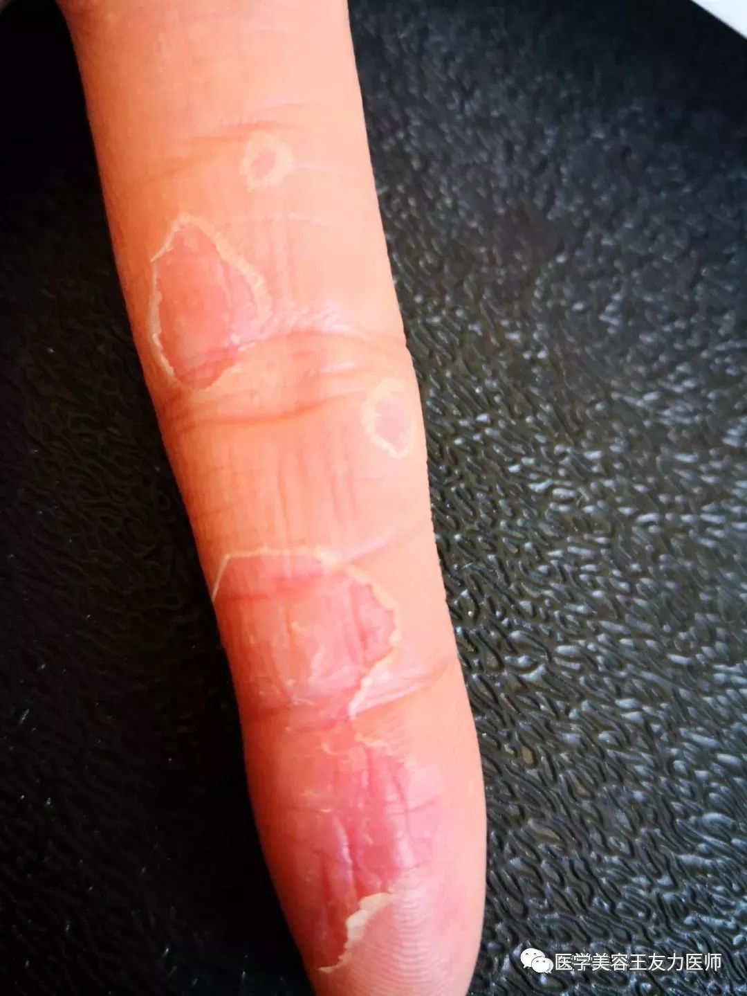 脱皮手膜真的有用吗_脱皮手裂脚裂用什么药膏好_手脱皮