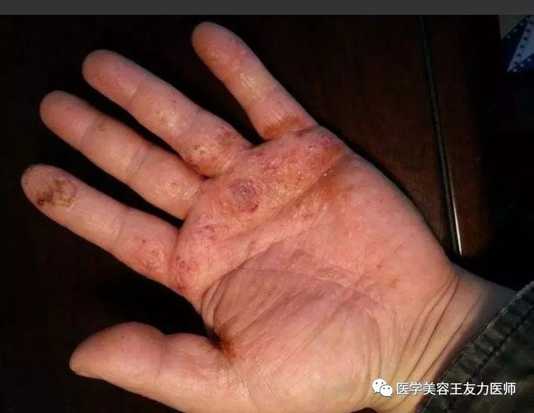 脱皮手膜真的有用吗_手脱皮_脱皮手裂脚裂用什么药膏好