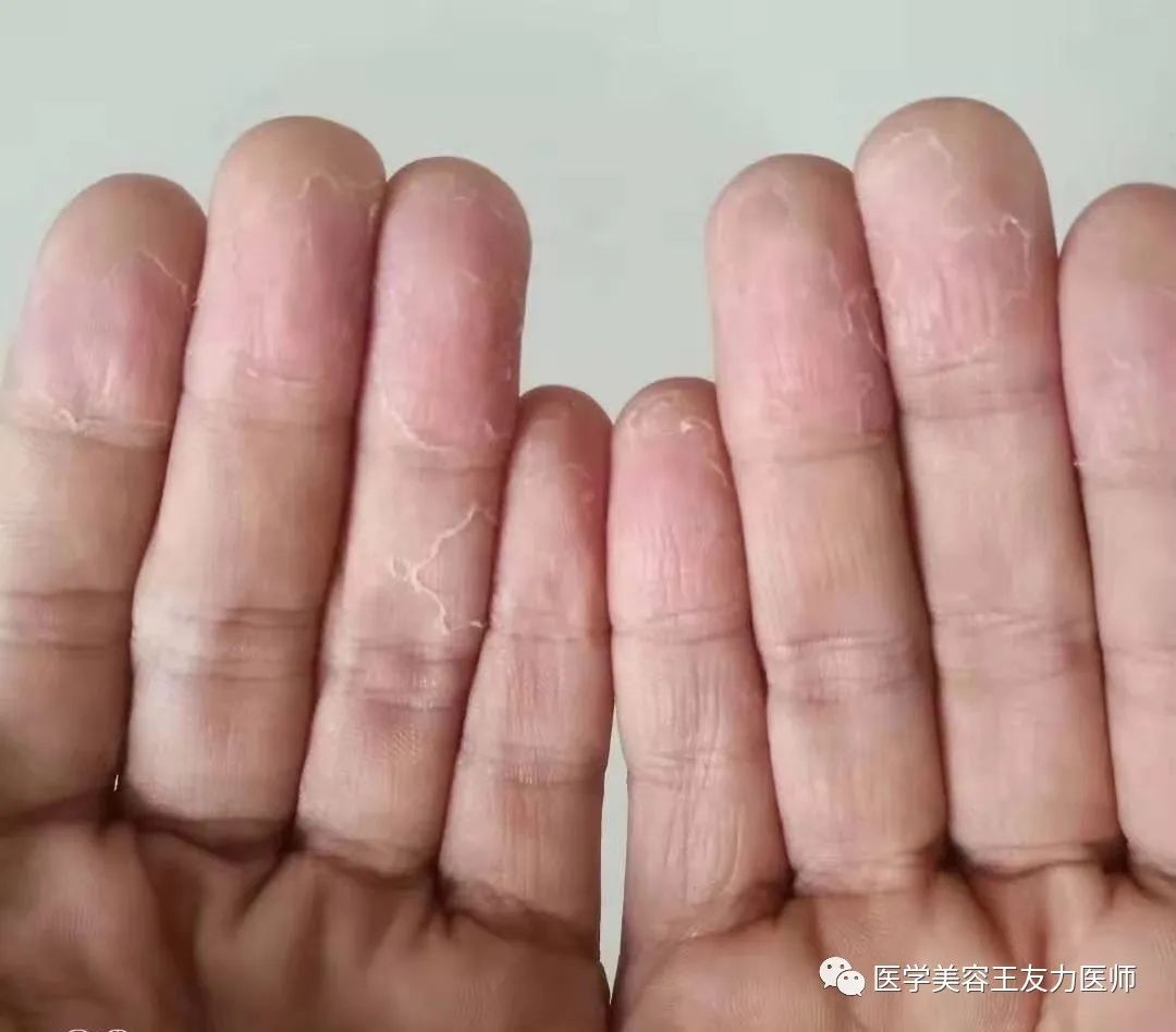 脱皮手裂脚裂用什么药膏好_手脱皮_脱皮手膜真的有用吗
