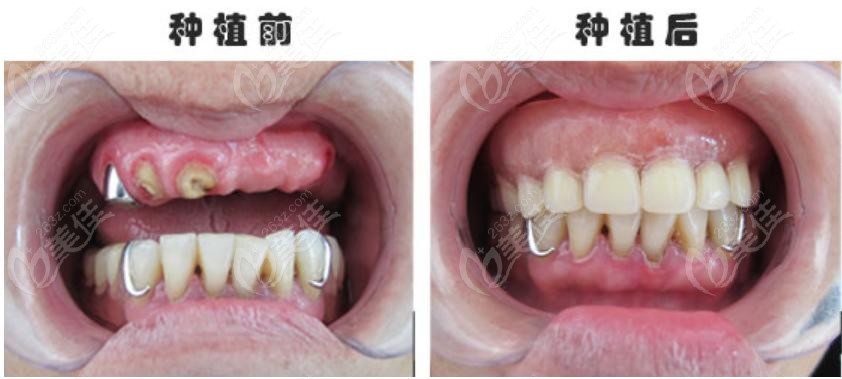桩牙冠_牙桩_桩牙套里面的牙疼