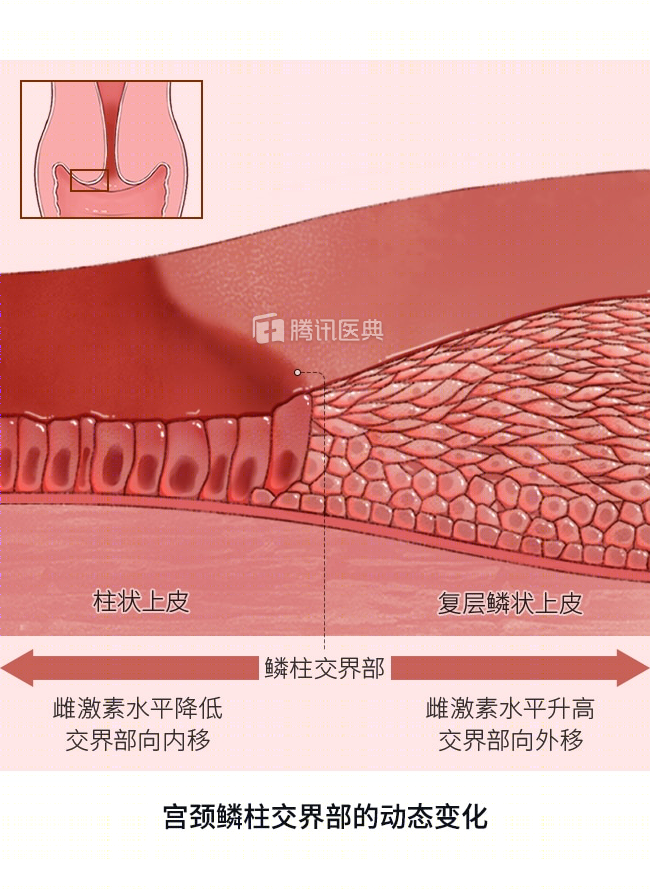 宫颈糜烂不用治？医生：确实！但这些检查必须做！