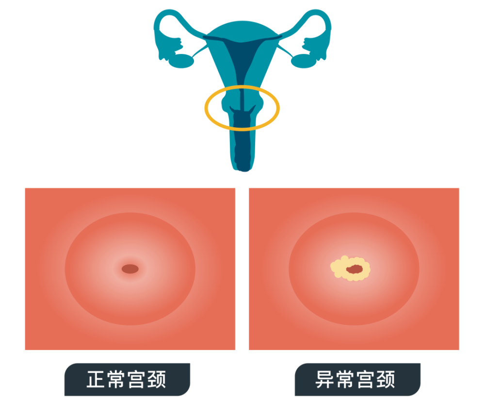 宫颈糜烂不用治？医生：确实！但这些检查必须做！