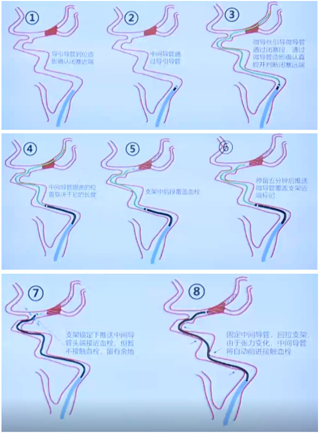 _造影的方法分几种方法_造影的方法
