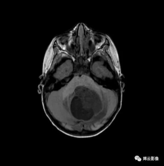 MR07-02-02-01  星形细胞瘤