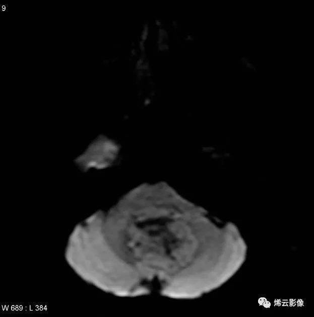 MR07-02-02-03 室管膜瘤