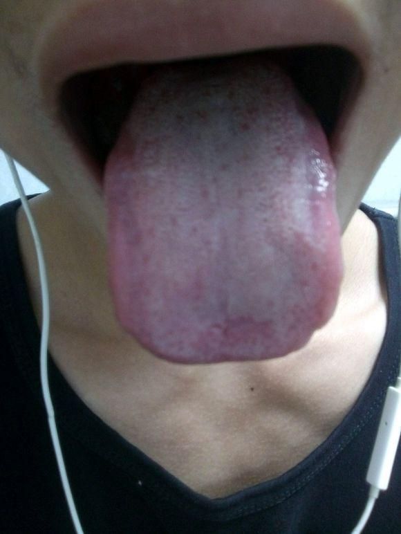 珍贵舌诊：肝郁气滞、阴虚火旺、脾胃虚寒的舌苔，看完记得存！