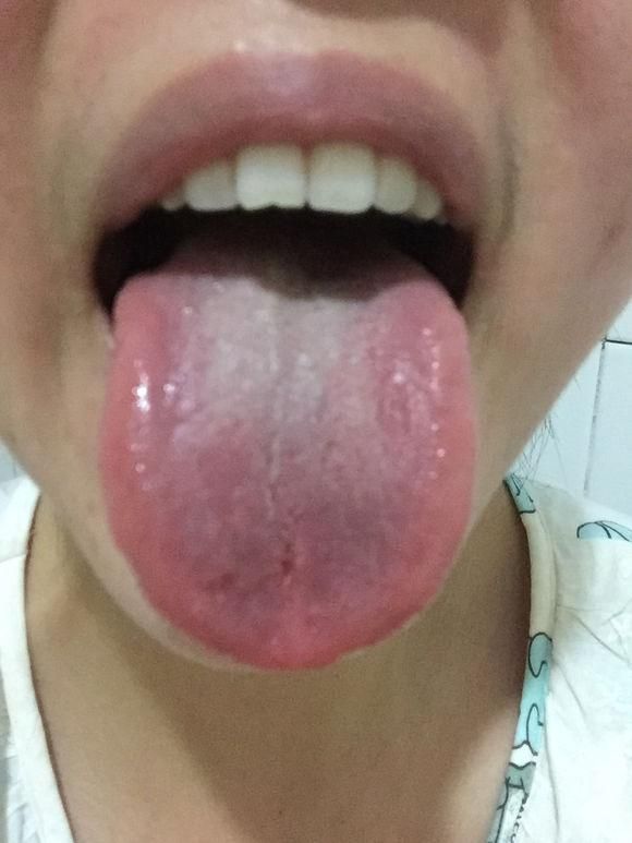 珍贵舌诊：肝郁气滞、阴虚火旺、脾胃虚寒的舌苔，看完记得存！