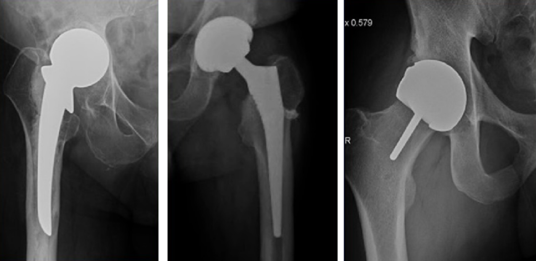 人工髋关节置换术，影像学评估要点看这里！
